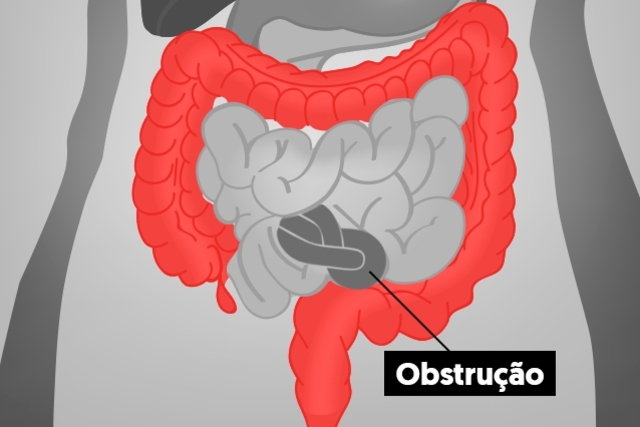 O que é obstrução intestinal e quais são os sintomas?