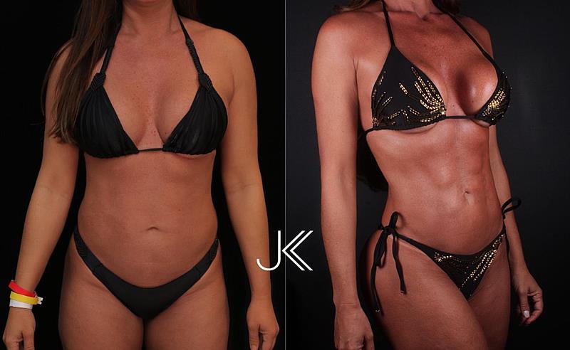 Nicole Bahls escolhe a LAD avançada JK e celebra transformação emocionante com resultado excepcional